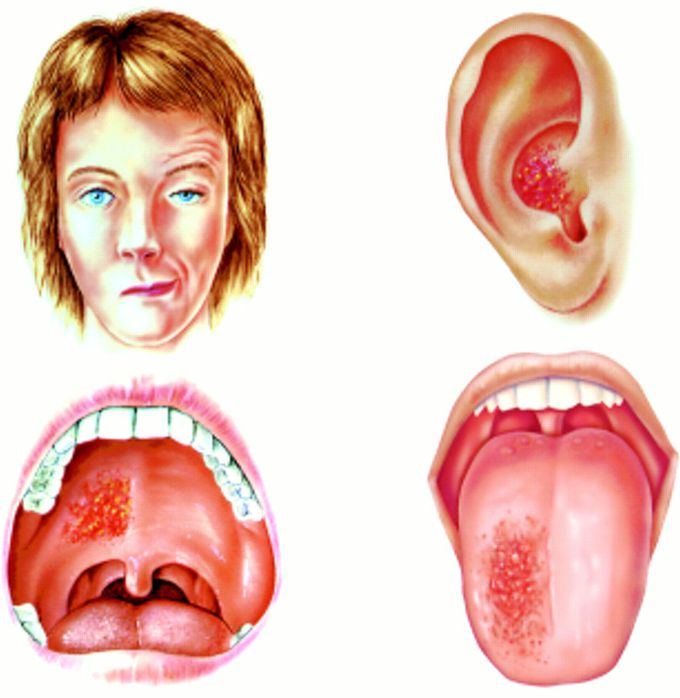 Cause of Ramsay Hunt syndrome