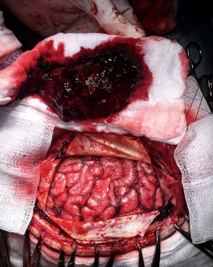 Huge left-sided spontaneous subdural hematoma in a 63-year-old male patient secondary to warfarin usage for his prosthetic cardiac valve.  