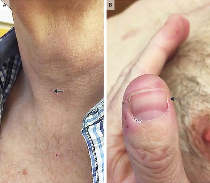 Corrigan’s Pulse and Quincke’s Pulse