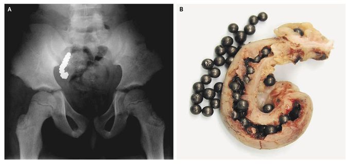 Pellets in the Appendix