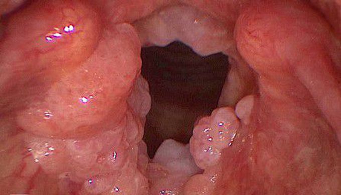 Cause of respiratory papillomatosis