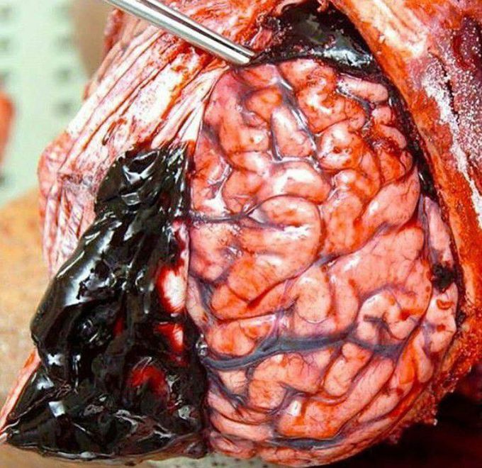 Subdural hematoma