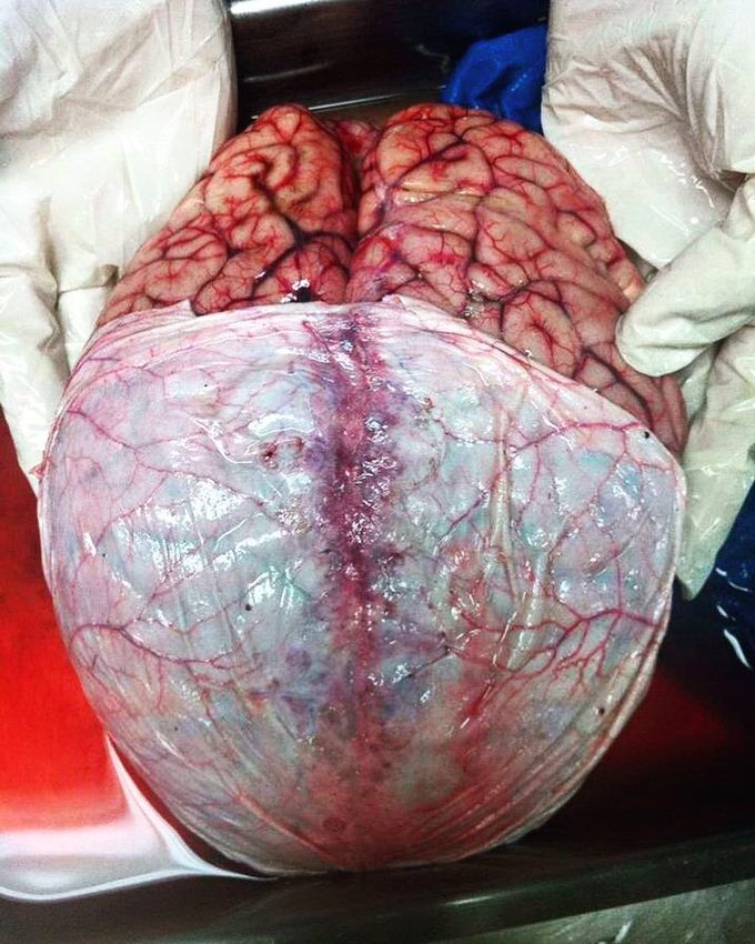 Fresh human brain with meninges peeled half way through 😮