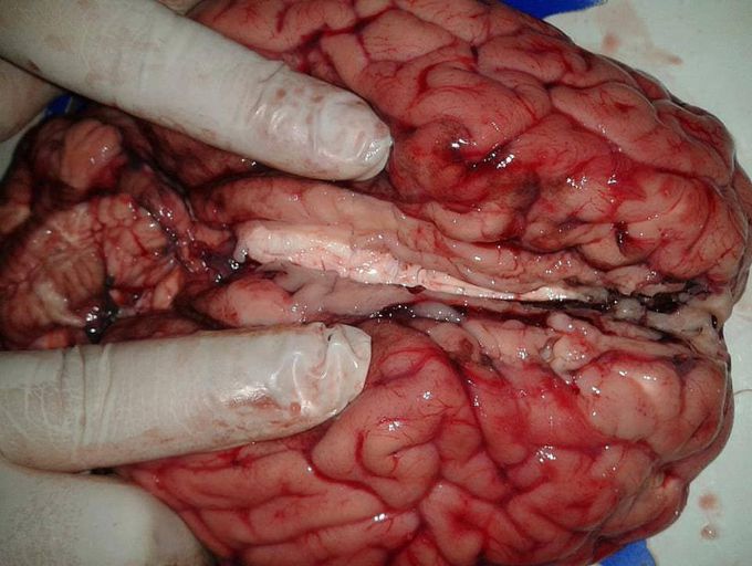 Corpus callosum