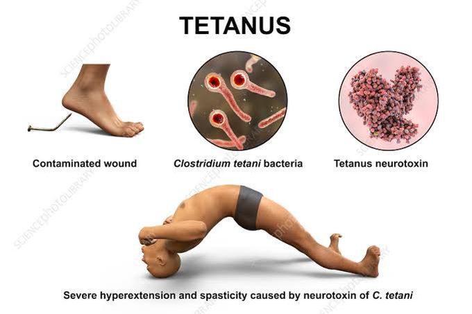 causes of tetanus