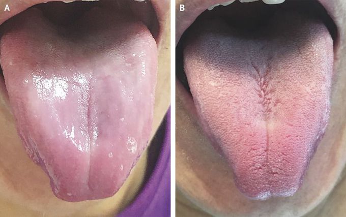 Atrophic Glossitis