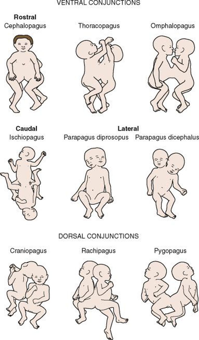 Types of conjoined twins!!
