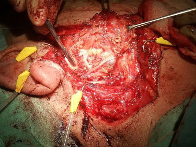 Parotidectomy