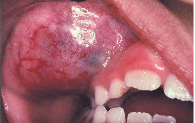 Embryonal Rhabdomyosarcoma