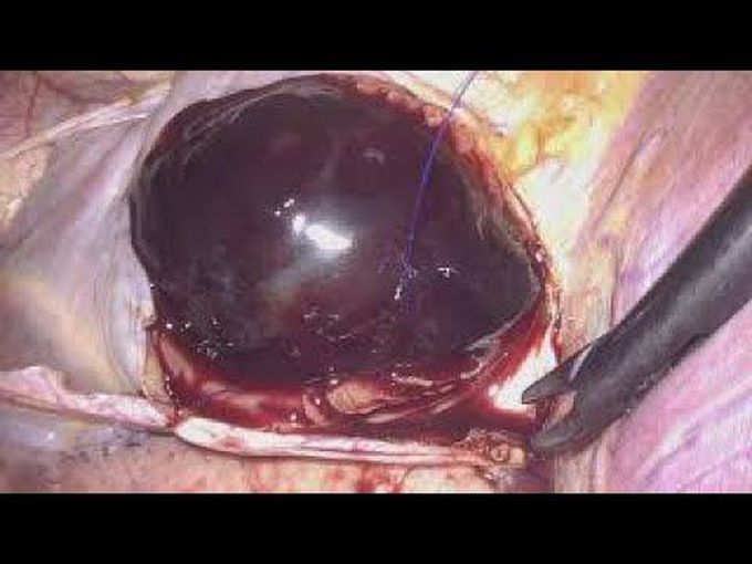 Totally Endoscopic Port-Access Artial Myxoma Resection Without Robotic Assistance