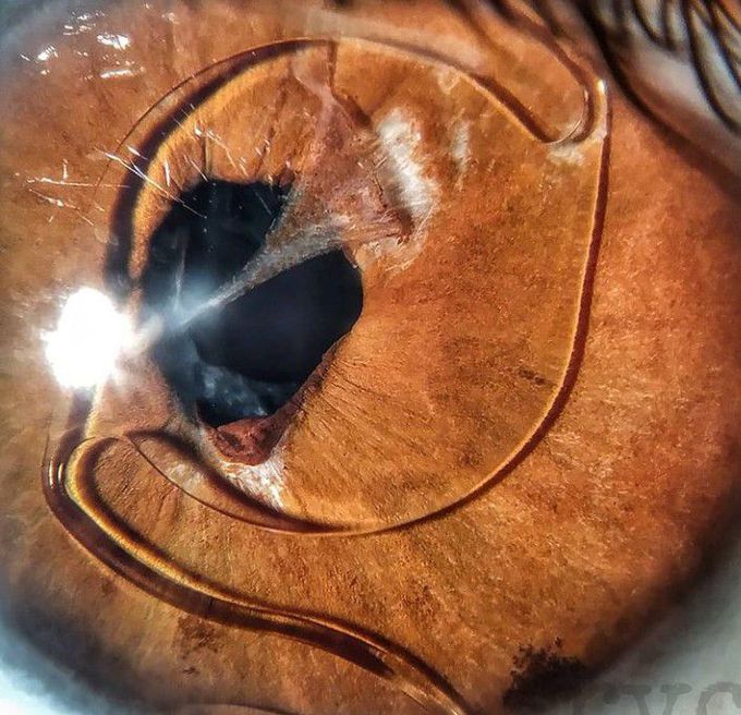 Anterior Chamber Intraocular Lenses