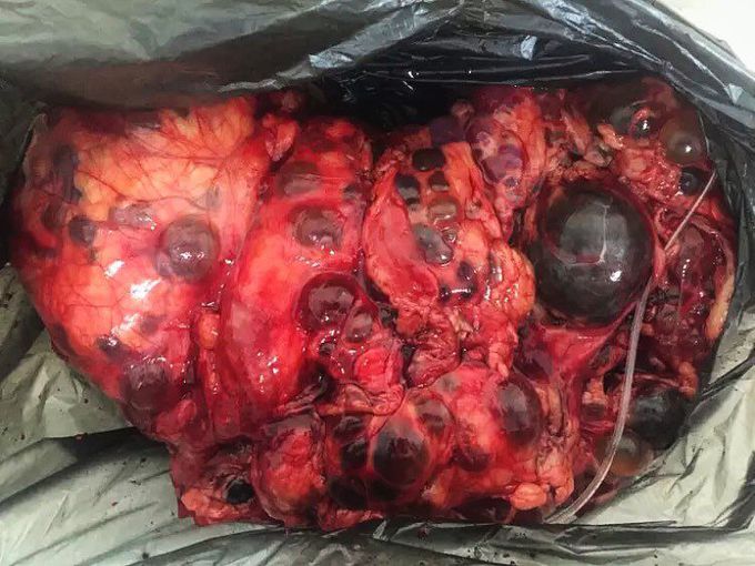 Polycystic horseshoe kidney