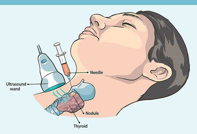Fine Needle Aspiration