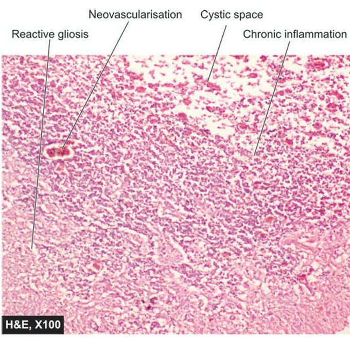 anaemic infarct