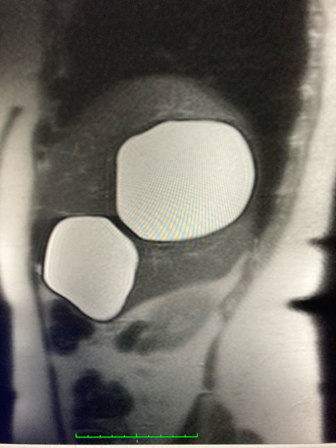 Echinococcal cysts of the liver.  Preferred laparoscopic surgery.