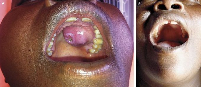 Syphilitic Gumma