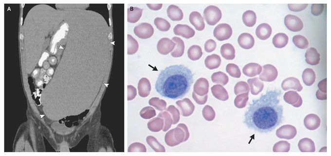 Massive Splenomegaly in Hairy-Cell Leukemia