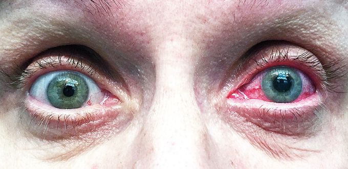 A 52-year-old woman presented to the emergency department with a 24-hour history of severe pain and blurred vision in the left eye. A left eye exam revealed a mid-dilated pupil unresponsive to light, red conjunctiva, diminished visual acuity, and increased intraocular pressure. What is the likely diagnosis?

Acute conjunctivitis  

Acute angle-closure glaucoma  

Acute orbital compartment syndrome  

Ulcerative keratitis  

Vitreous hemorrhage