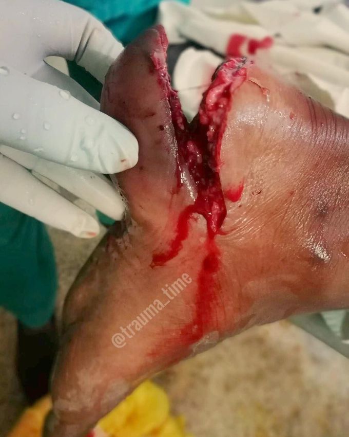 Traumatic heel avulsion