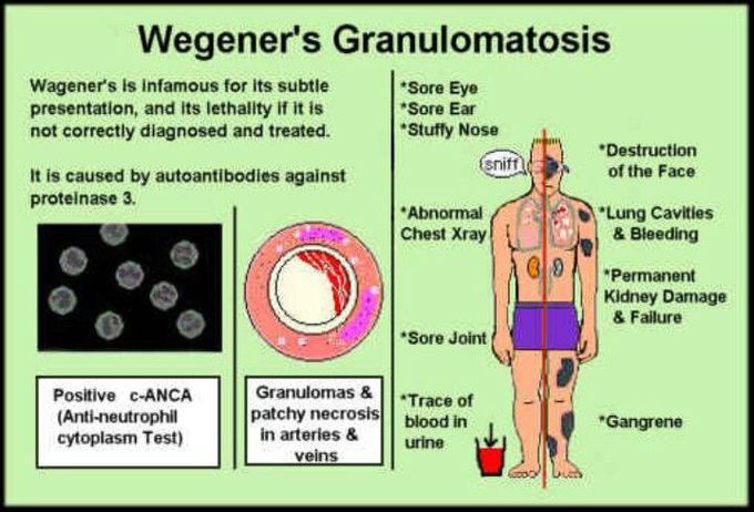 Wegener's Granulomatosis