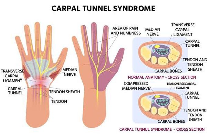 Causes of carpal tunnel syndrome