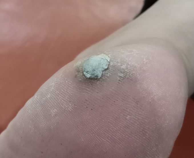 Warts