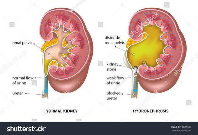 Hydronephrosis treatment