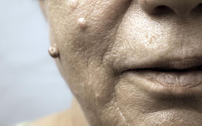 Facial warts