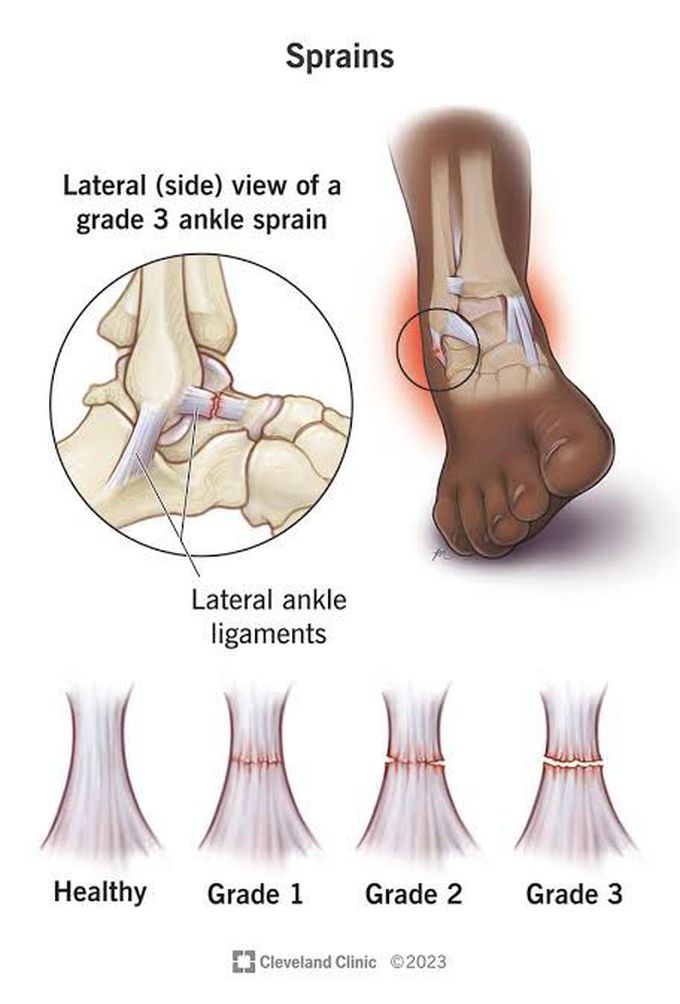 Sprain Grades