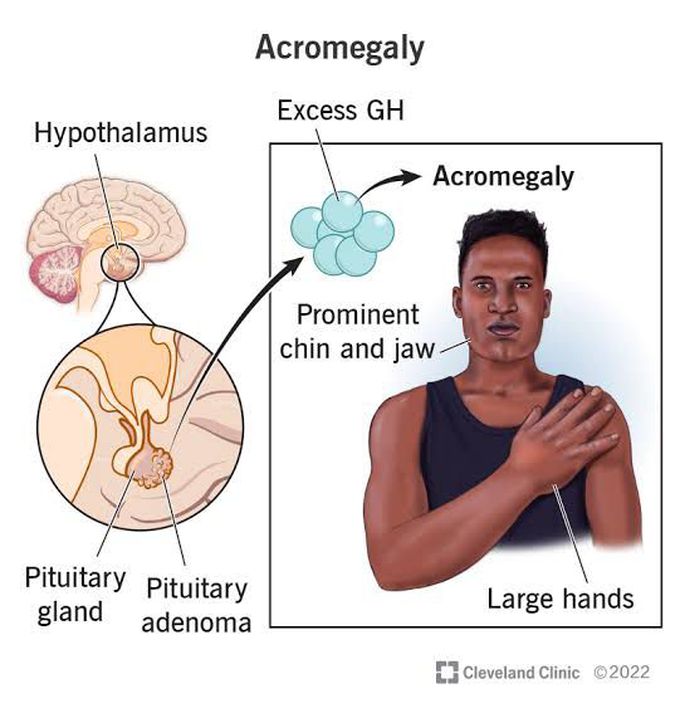 Acromegaly