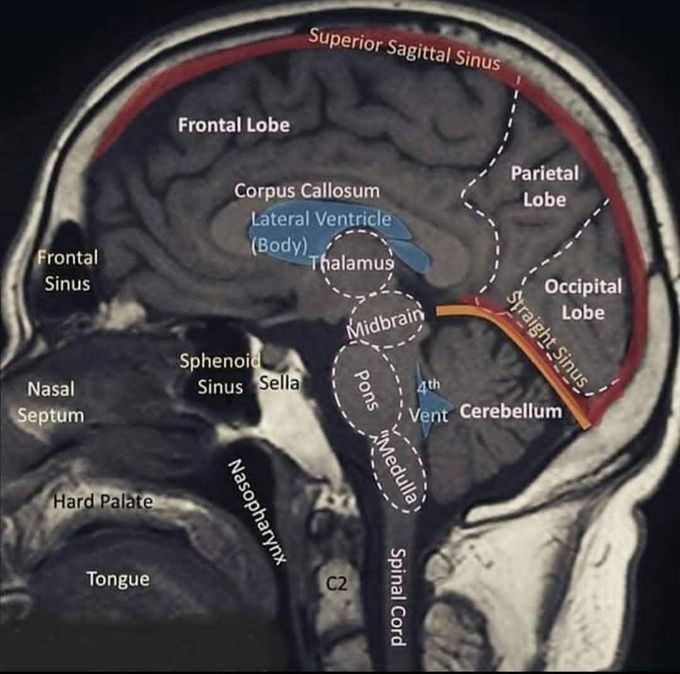 Well labelled MRI  of the BRAIN
