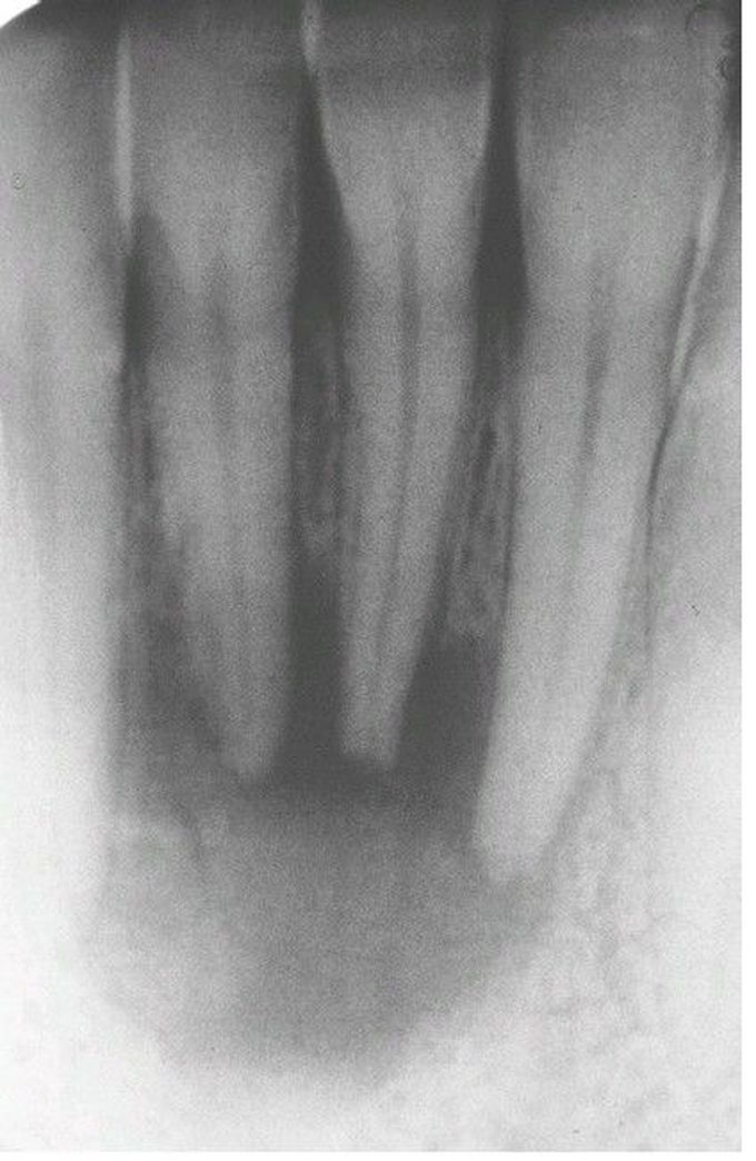 Periapical Abscess