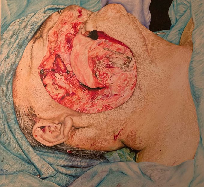 Surgery for carcinoma of the buccal mucosa