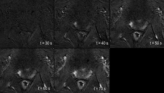 Prostate perfusion-weighted imaging (PWI)