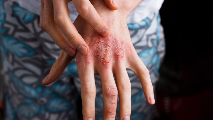Complications of atopic dermatitis