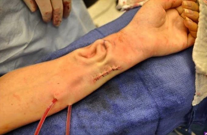 Doctors at Johns Hopkins have attached a new ear to a patient that was grown on her own forearm. 
