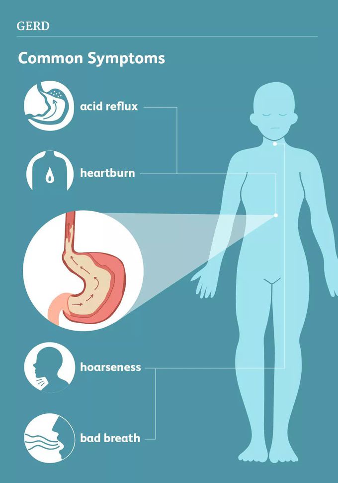 Common Symptoms of GERD