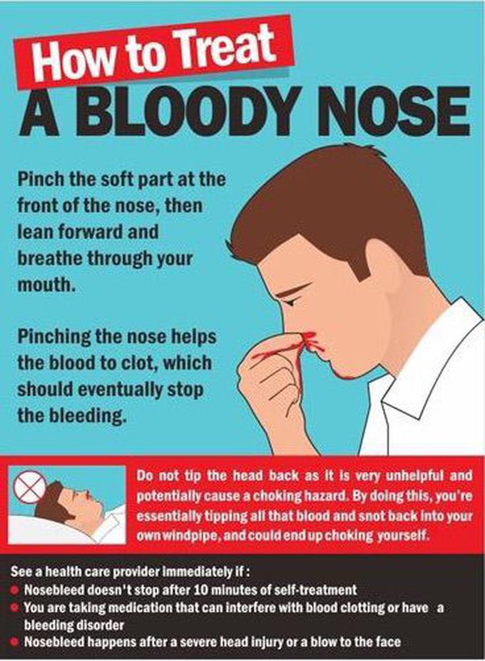 How to treat nosebleeds medizzy