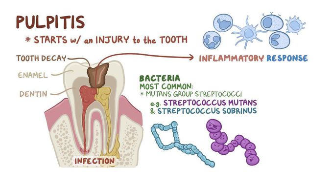 Pulpitis