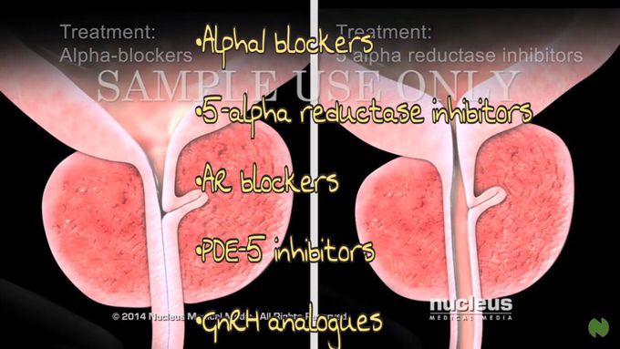 Benign Prostatic Hyperplasia