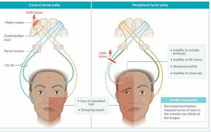 🟢FACIAL NERVE PALSY 🔻