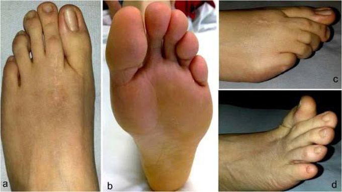 Treatment of frieberg disease