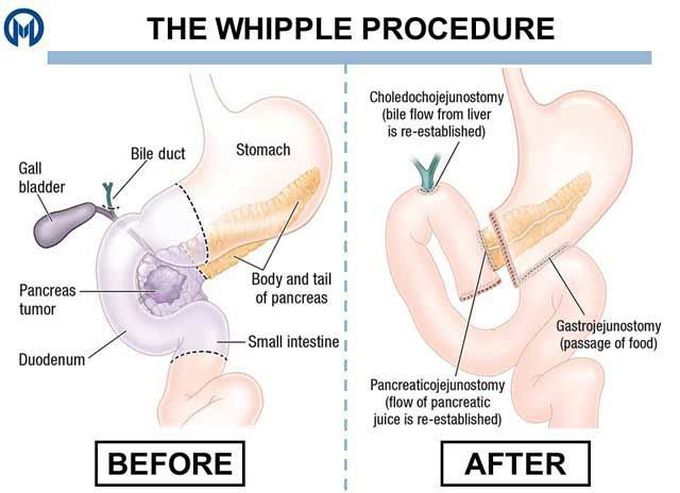 Whipple Procedure
