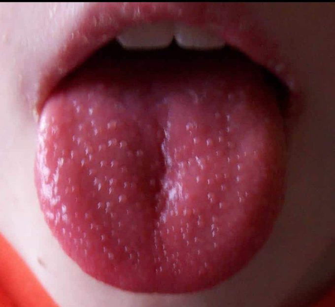 Strawberry tongue