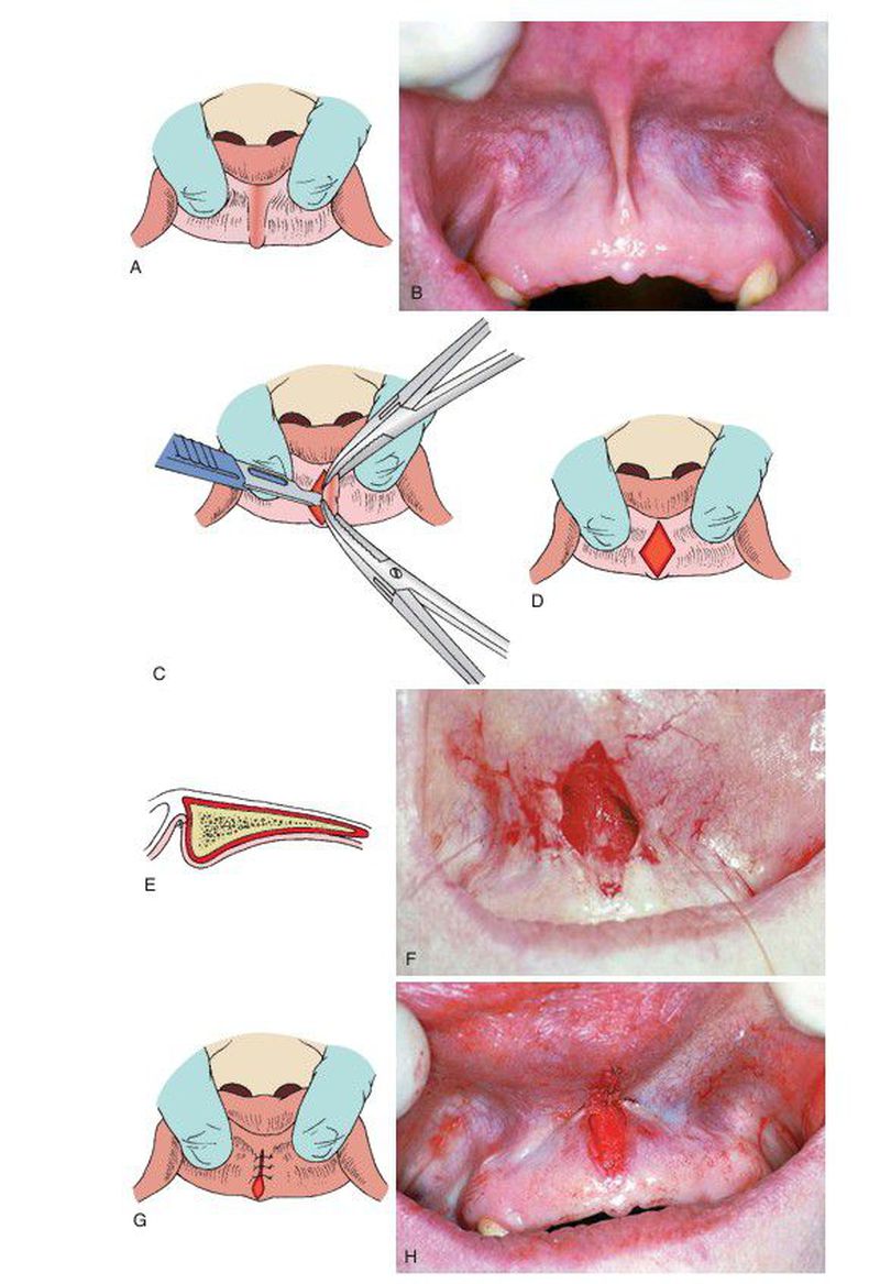 A frenectomy is a surgical procedure to remove a frenulum, a small fold of  tissue that restricts movement. It's commonly done in the mouth to address  issues like tongue-tie or lip-tie, which can ..., image size:800x1167