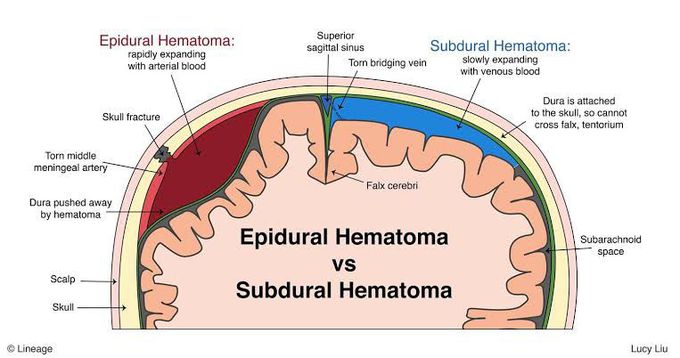 Epidural Hematoma Vs Subdural Hematoma