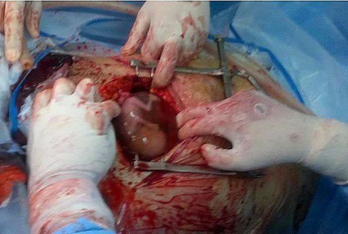 The rarest localization of ectopic pregnancy - Intramyometrial!!
