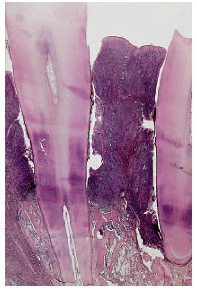 Acute myelomonocytic leukaemia