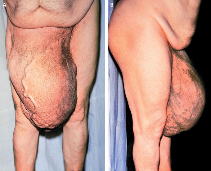 Large Right Inguinal Hernia