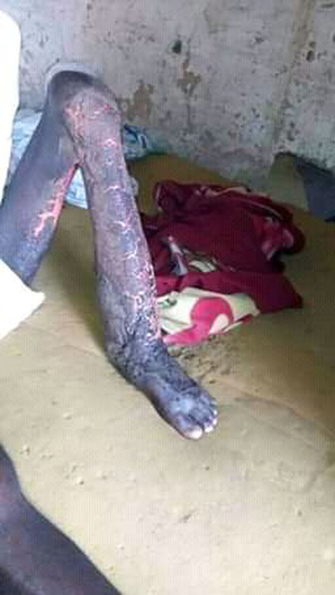 Please you diagnosis, treatment, cause, prevention, epidemiology on this  bacterialpathogens.